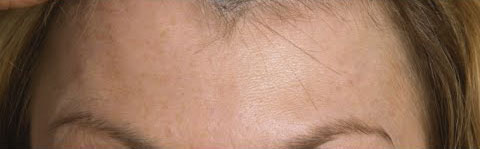 Frontal wrinkles compared after