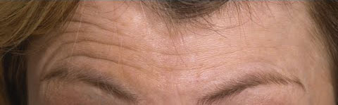 Frontal wrinkles compared before