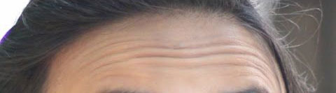 Frontal wrinkles compared before