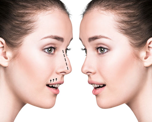 Nekirurška korekcija nosa