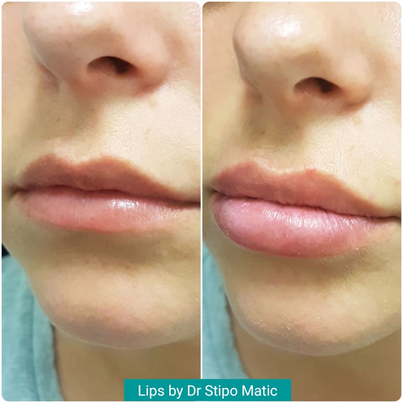 Lip Fillers Maticlinic Aesthetics ǀ Anti Wrinkle Injections ǀ Dermal