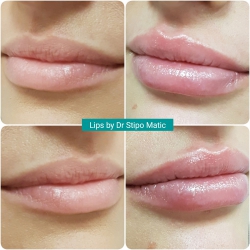 Lips by Dr Stipo Matic