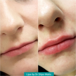Lips by Dr Stipo Matic
